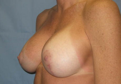 Breast Reduction with Augmentation case #3633