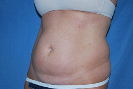 Liposuction case #4503