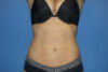 Liposuction case #4514