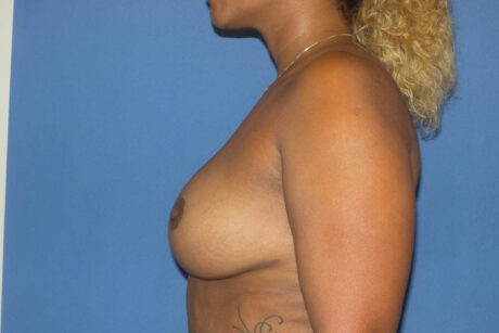 Breast Reduction case #4034