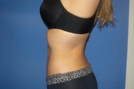 Liposuction case #4514