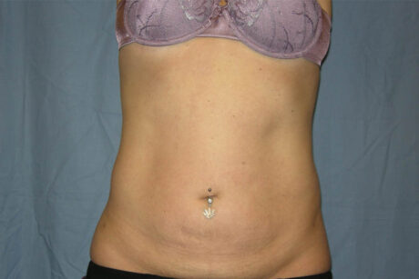 Liposuction case #4525