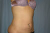 Liposuction case #4525