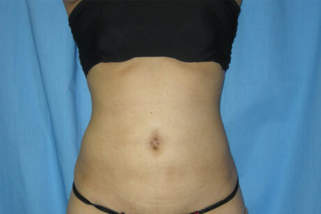 Liposuction case #4536