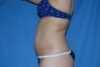 Liposuction case #4536