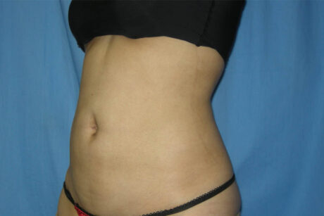 Liposuction case #4536