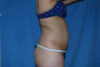 Liposuction case #4536