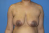 Breast Reduction case #4063