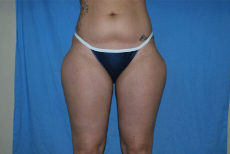 Liposuction case #4547