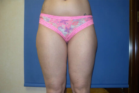 Liposuction case #4547