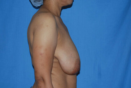 Breast Reduction case #4066