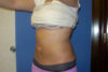 Liposuction case #4550