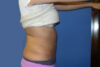 Liposuction case #4550