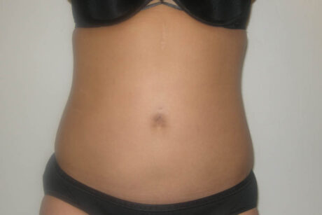 Liposuction case #4561