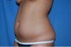 Liposuction case #4561