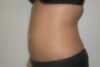 Liposuction case #4561