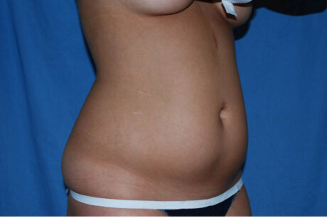 Liposuction case #4561