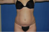 Liposuction case #4568