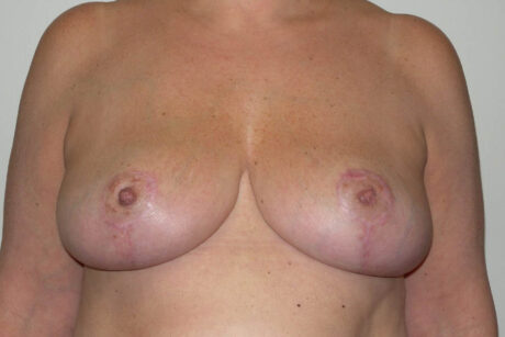 Breast Reduction case #4086