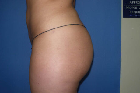 Liposuction case #4568