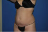 Liposuction case #4568