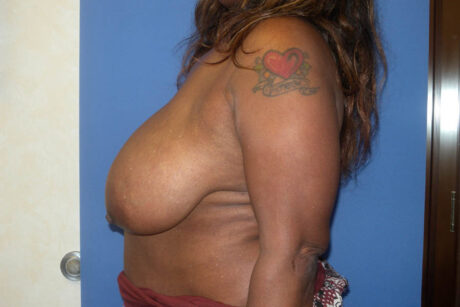 Breast Reduction case #4108