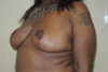 Breast Reduction case #4108