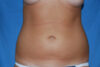 Liposuction case #4596