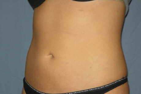 Liposuction case #4596