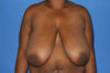 Breast Reduction case #4133