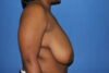 Breast Reduction case #4133