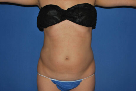 Liposuction case #4618