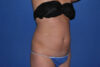 Liposuction case #4618