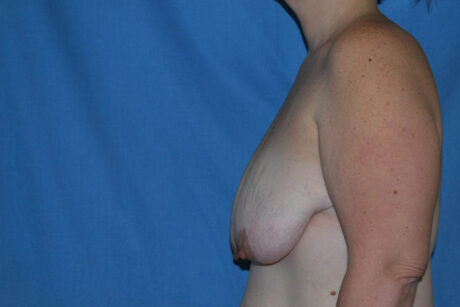 Breast Reduction case #4144