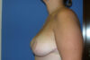 Breast Reduction case #4144