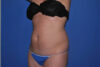 Liposuction case #4618