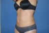 Liposuction case #4618