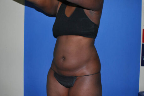 Liposuction case #4629