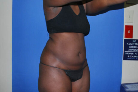 Liposuction case #4629