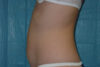 Liposuction case #4640