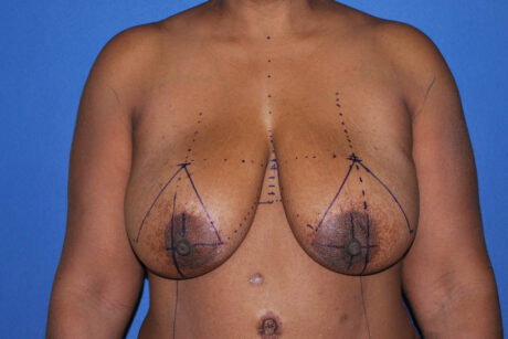 Breast Reduction case #4171