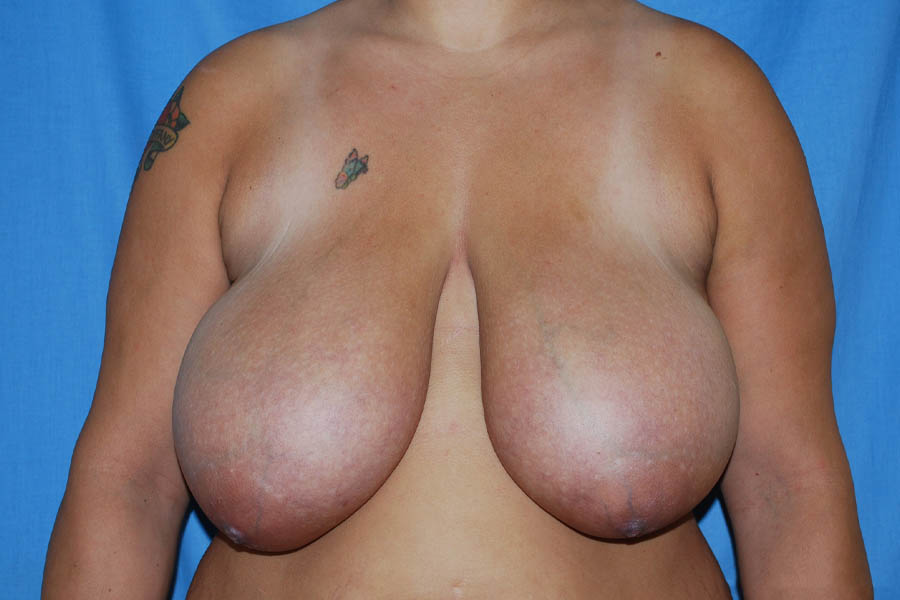 Breast Reduction case #4174