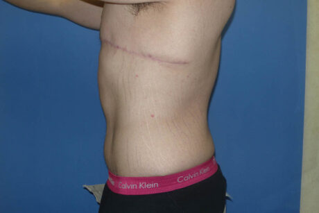 Tummy Tuck case #5450