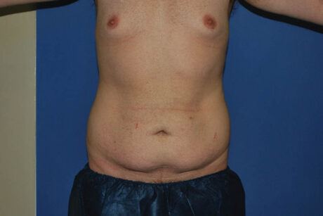 Tummy Tuck case #5463