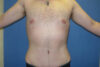 Tummy Tuck case #5463