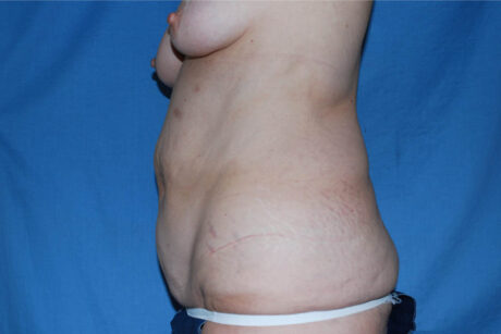 Liposuction case #4685