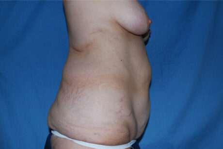 Liposuction case #4685