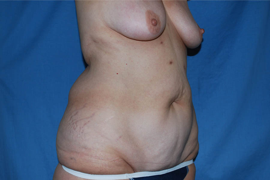 Liposuction case #4685