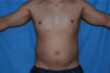 Liposuction case #4716