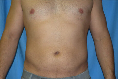 Liposuction case #4716